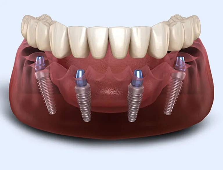 All-On-4 dental implant technique