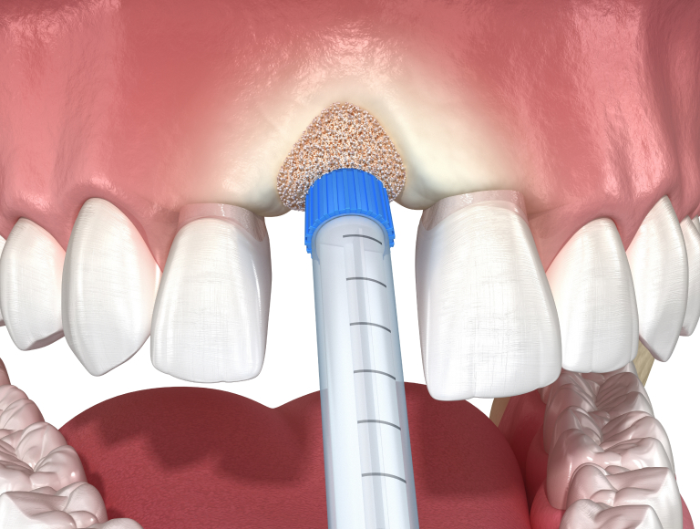 You Need Bone Grafting to Support Your Smile