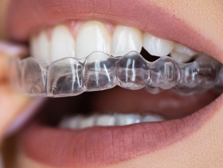 Clear Aligner Therapy Right for You