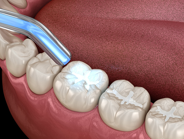 Is It Time for a Dental Filling?