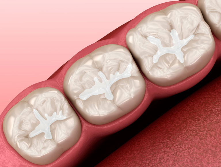 Dental Sealants