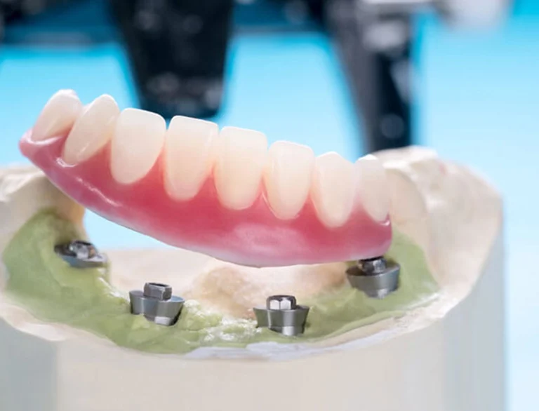 Implant-supported dentures in Elk Grove