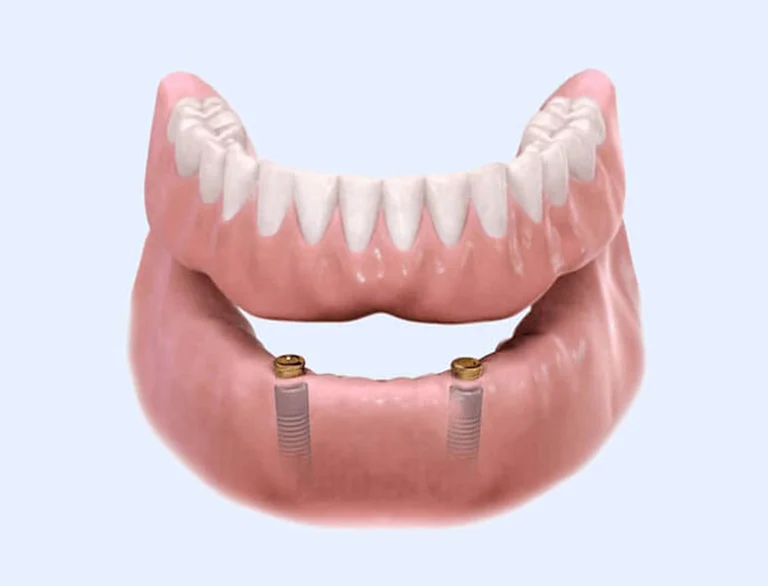 Fixed vs removable dental implant solutions