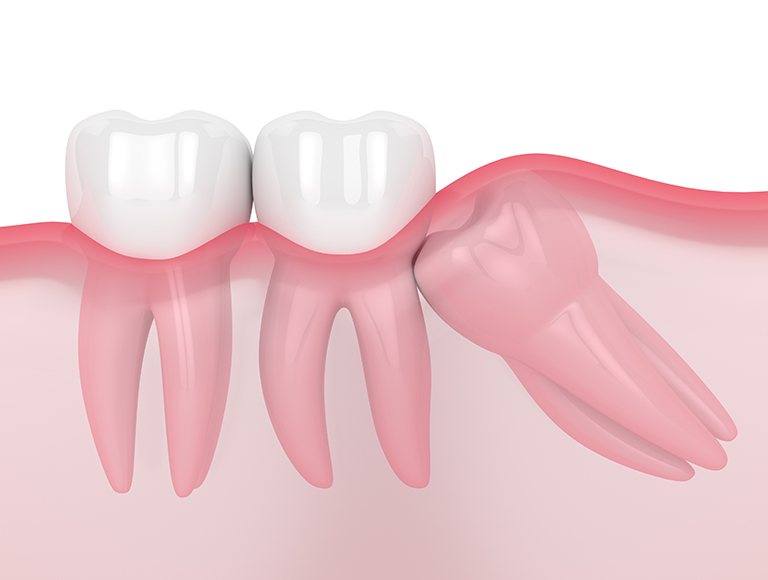 Are Your Wisdom Teeth Causing Trouble?