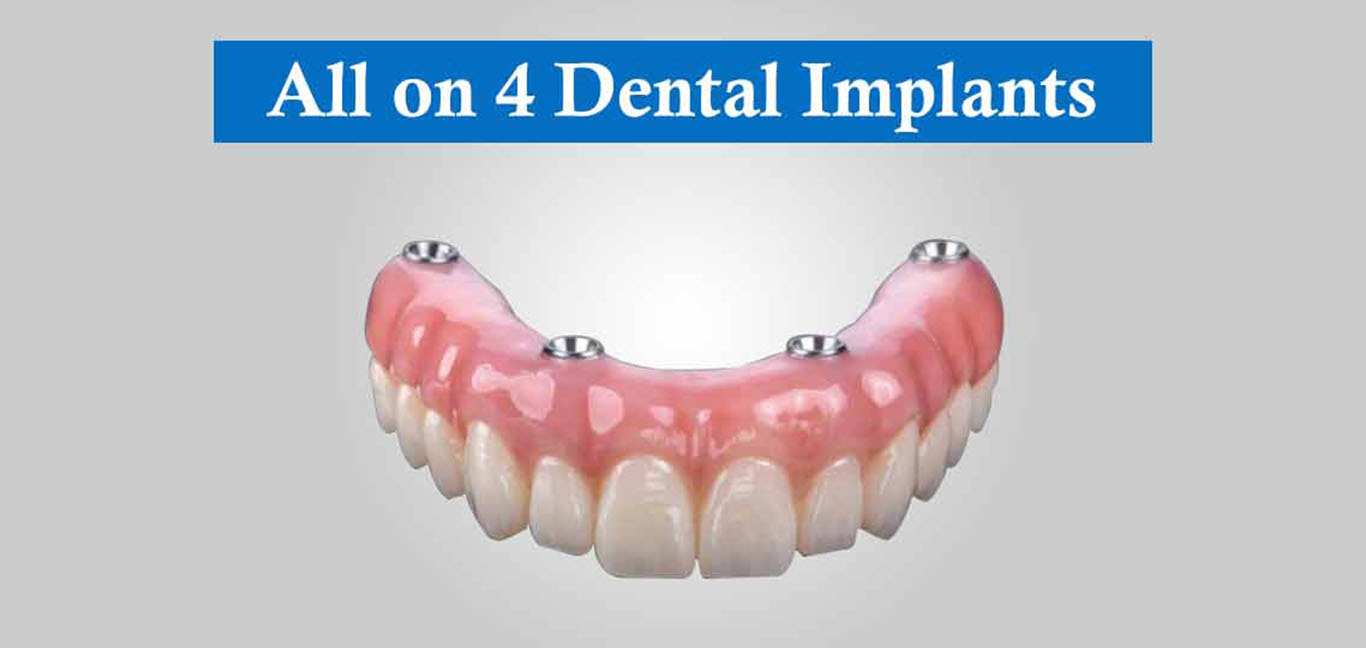 All-on-4 Dental Implants